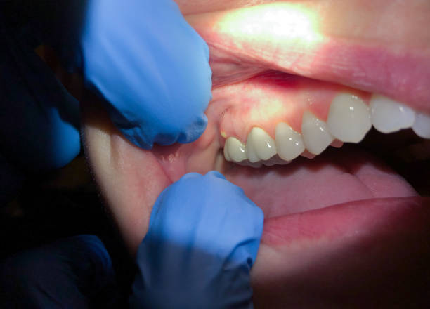 Best Emergency Treatment for Dental Infections or Abscesses in Shpee Neck, MA